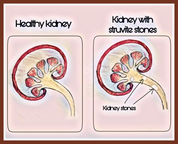 Infective bacterial kidney stone struvite stone
