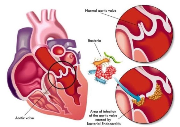 Bacterial or Infective endocarditis, Biofilm